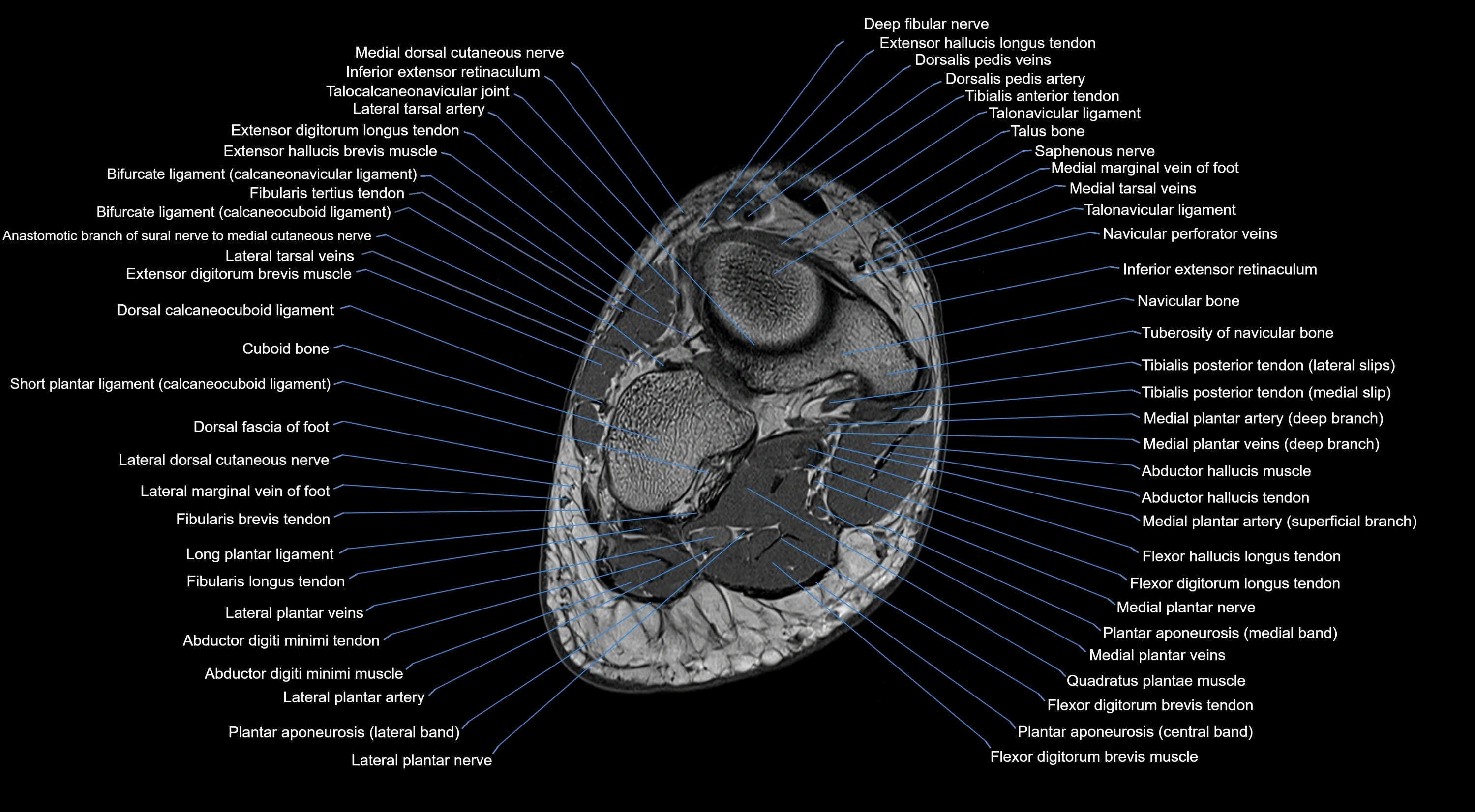 MRI mid foot coronal ligaments cross sectional anatomy 3T  radiology  image-img-00001-00033.webp